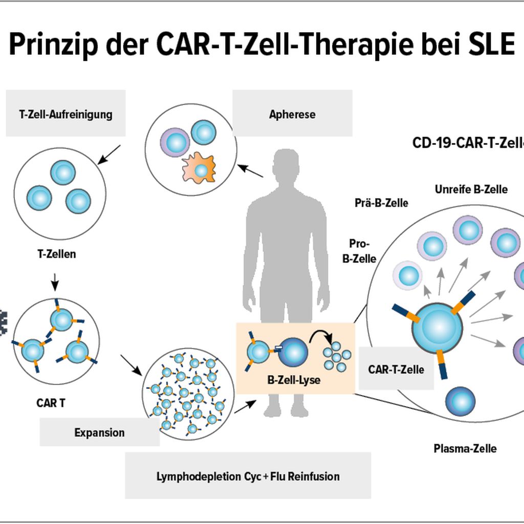 CAR-T-Zell-Therapie beim systemischen Lupus – ein neuer Meilenstein ...